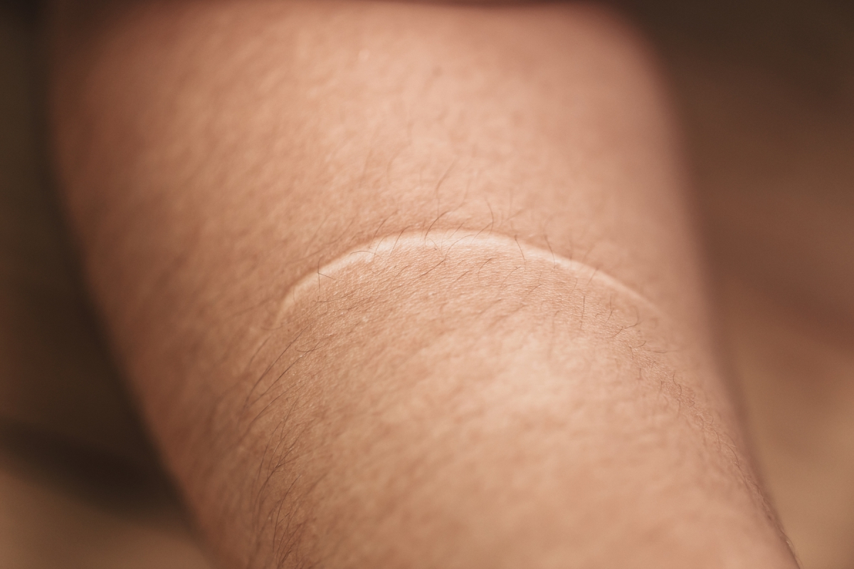 Bild einer Narbe auf dem Unterarm eines Menschen