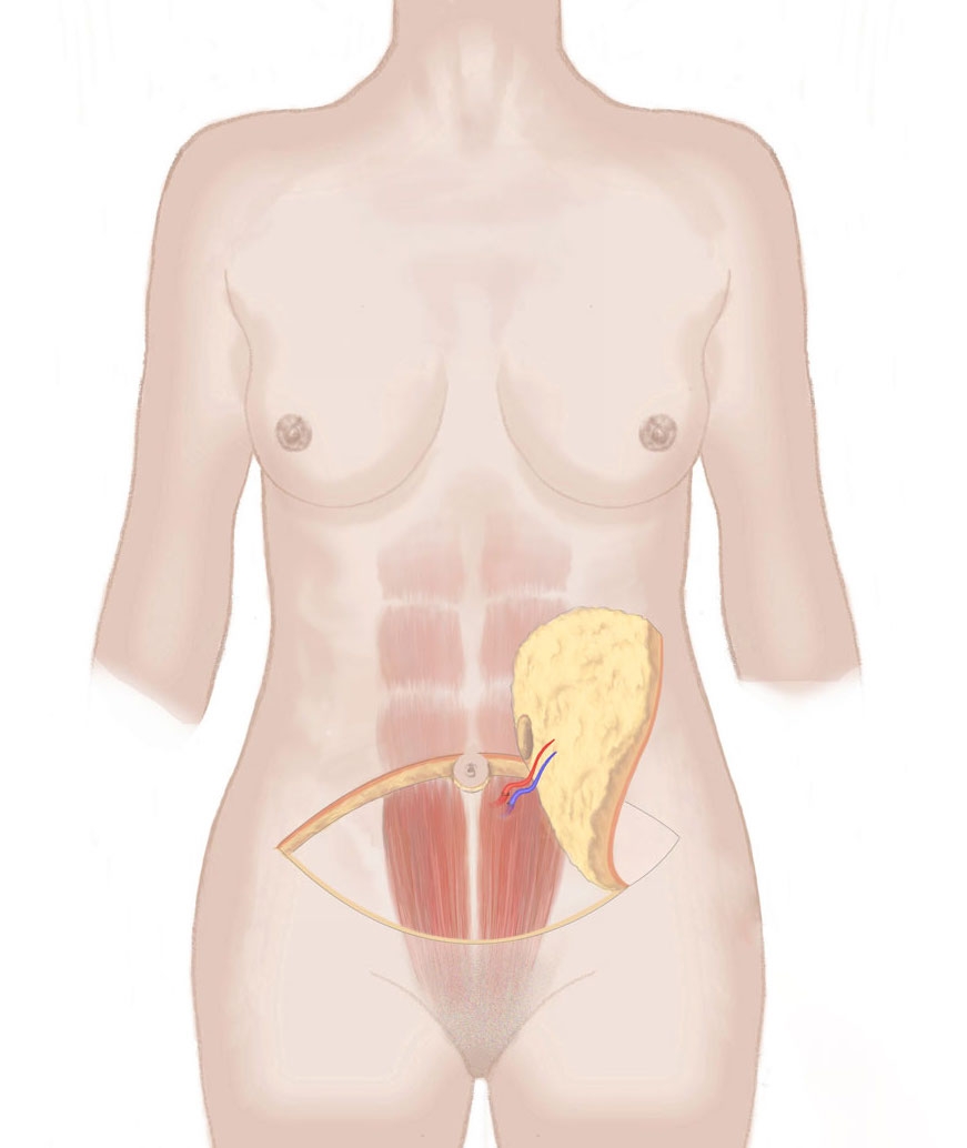 Diagram Gewebeentnahme DIEP Lappen