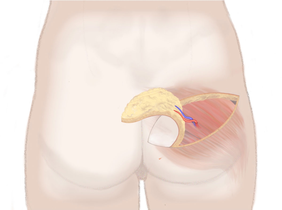 Diagram Gewebeentnahme PAP Lappen