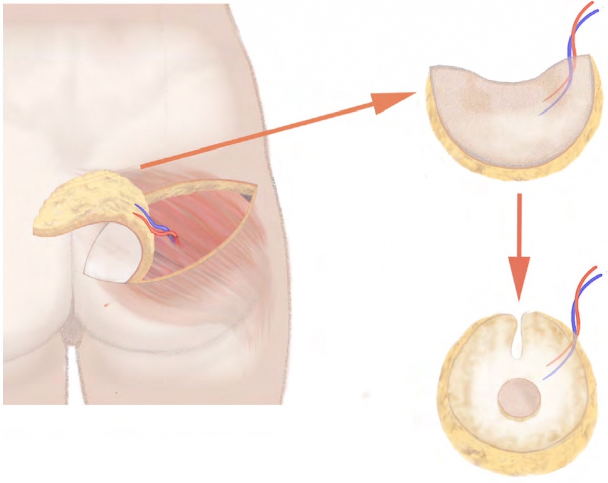 Diagram Gewebeentnahme S-GAP Lappen