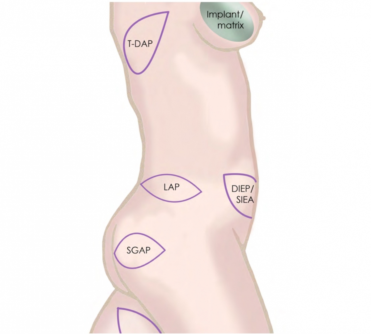 Diagram Gewebeentnahme von der Flanke